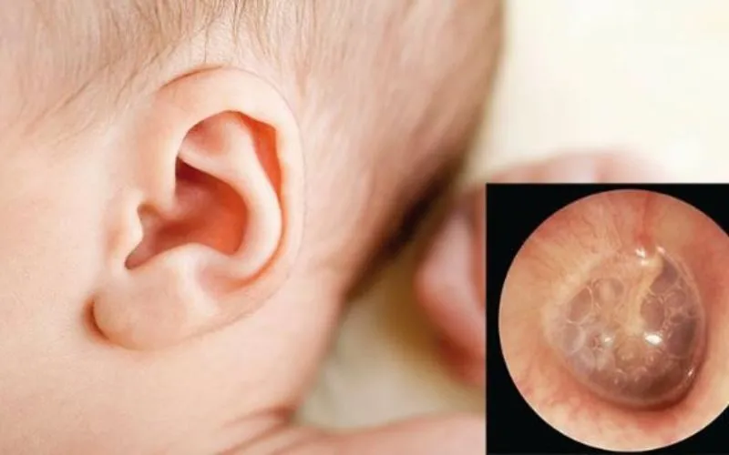 Rửa mũi có gây viêm tai không? Sự thật bất ngờ